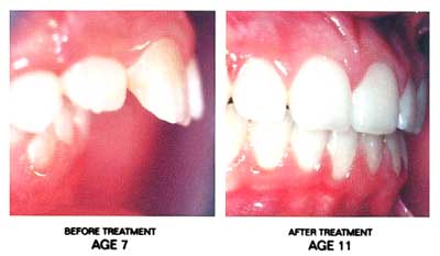 Functional Appliances Before & After Treatment Huntley | Faubl Family Dentistry in Huntley